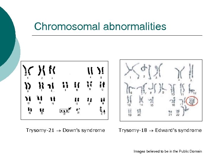 Chromosomal abnormalities Trysomy-21 Down’s syndrome Trysomy-18 Edward’s syndrome Images believed to be in the