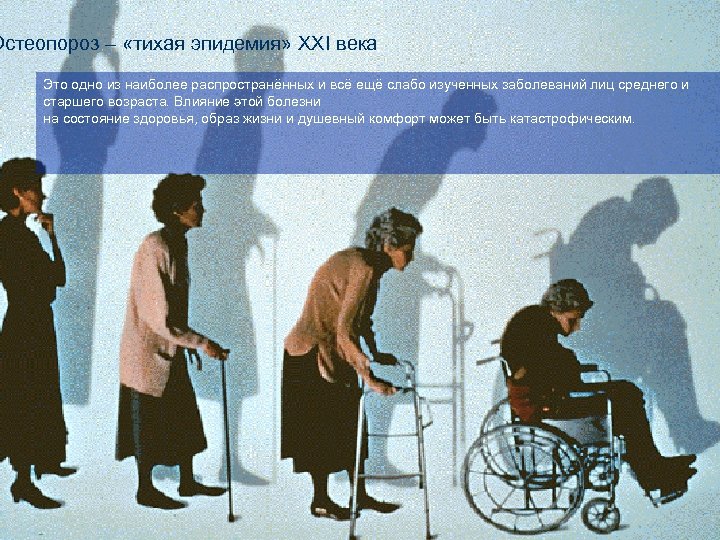 Остеопороз – «тихая эпидемия» XXI века Это одно из наиболее распространённых и всё ещё