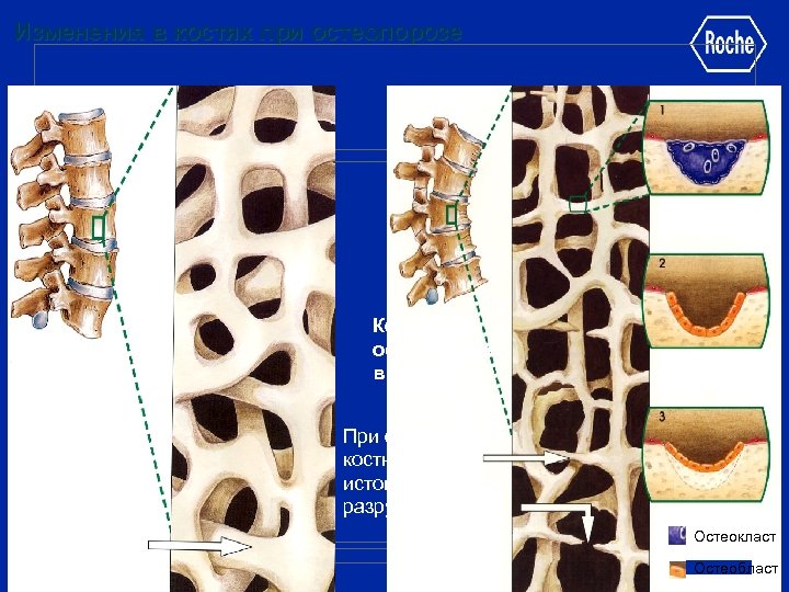 Изменения в костях при остеопорозе Нормальная кость в 30 лет В норме костные балки