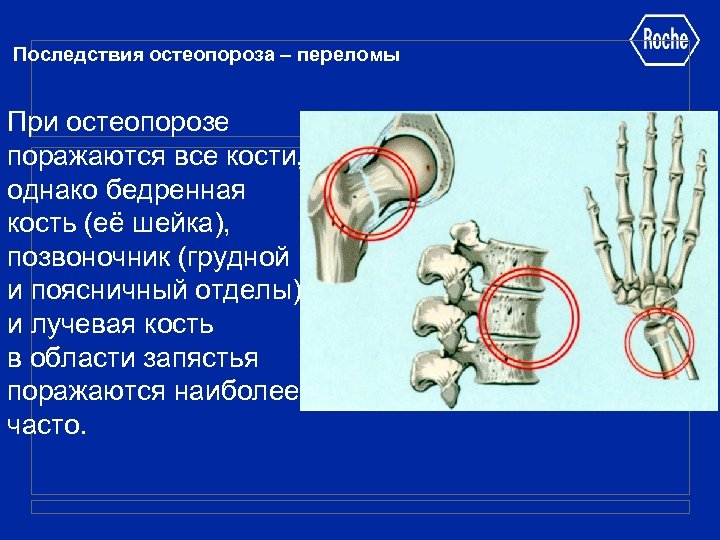Последствия остеопороза – переломы При остеопорозе поражаются все кости, однако бедренная кость (её шейка),