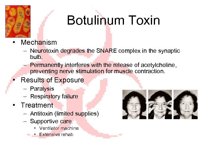 Botulinum Toxin • Mechanism – Neurotoxin degrades the SNARE complex in the synaptic bulb.