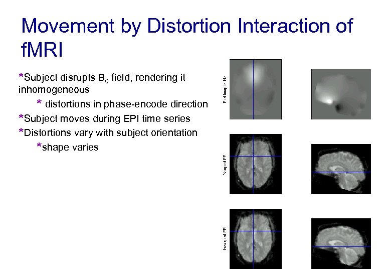 Movement by Distortion Interaction of f. MRI *Subject disrupts B 0 field, rendering it