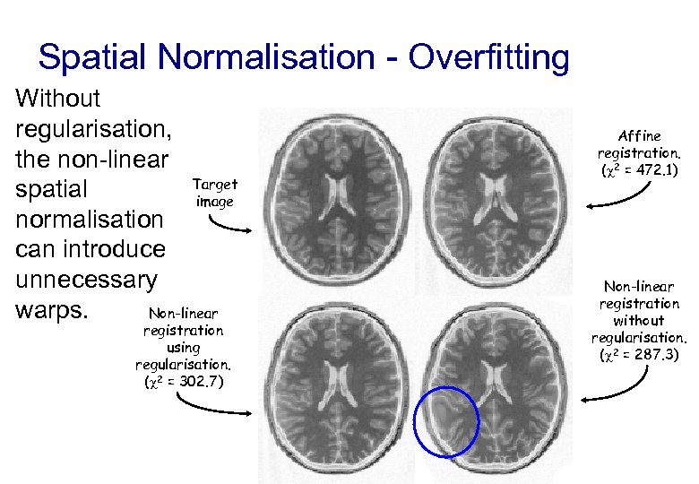 Spatial Normalisation - Overfitting Without regularisation, the non-linear Target spatial image normalisation can introduce