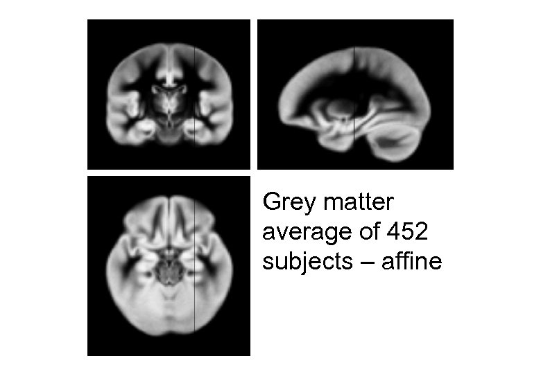 Grey matter average of 452 subjects – affine 