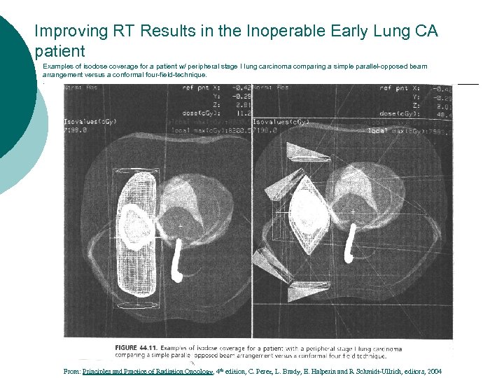 Improving RT Results in the Inoperable Early Lung CA patient Examples of isodose coverage
