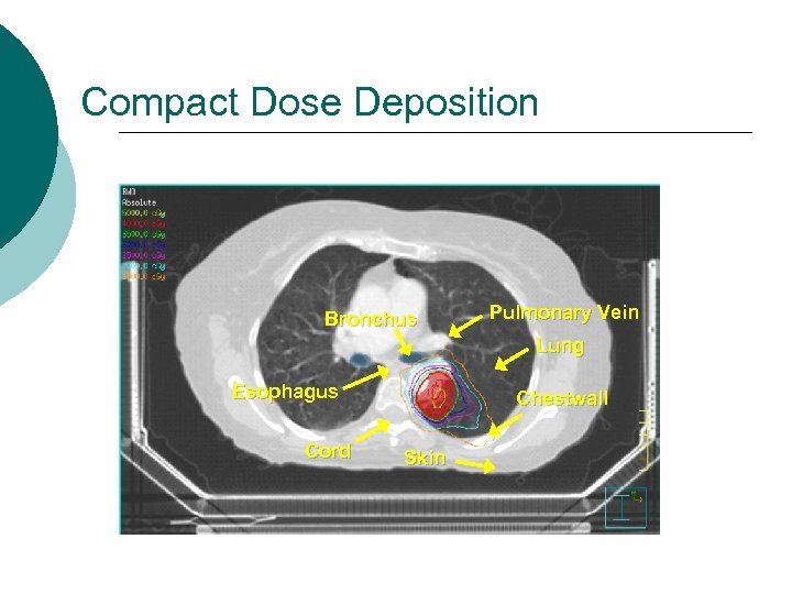 Compact Dose Deposition Bronchus Pulmonary Vein Lung Esophagus Cord Chestwall Skin 