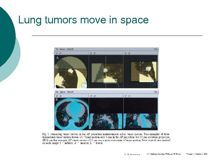 Lung tumors move in space 