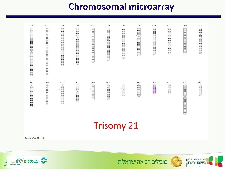 Chromosomal microarray Trisomy 21 