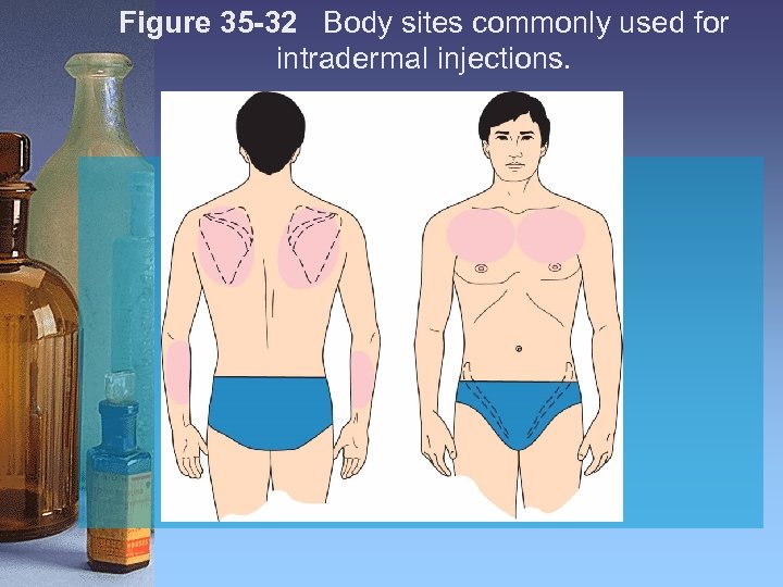 Figure 35 -32 Body sites commonly used for intradermal injections. 