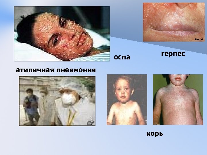 оспа герпес атипичная пневмония корь 