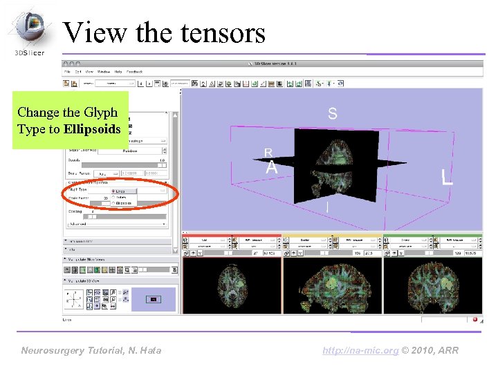 View the tensors Change the Glyph Type to Ellipsoids Neurosurgery Tutorial, Hata Neurosurgery Tutorial,