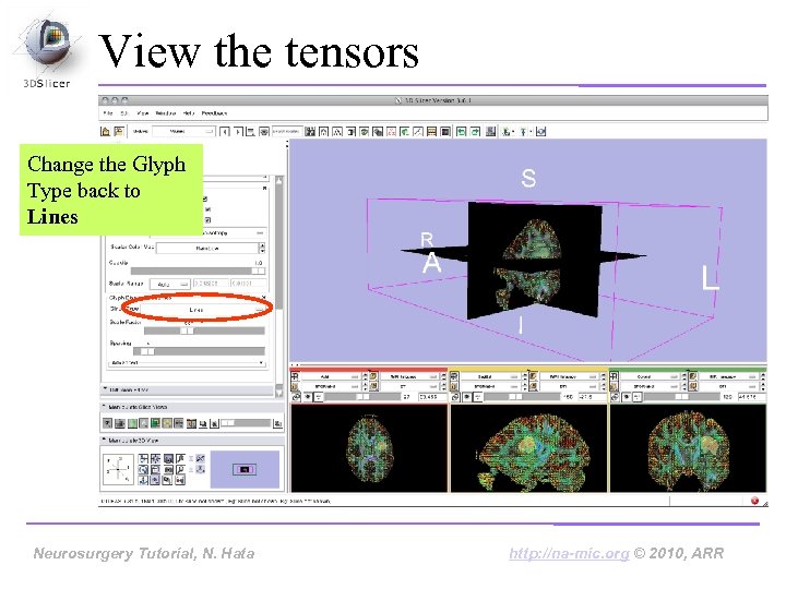 View the tensors Change the Glyph Type back to Lines Neurosurgery Tutorial, Hata Neurosurgery