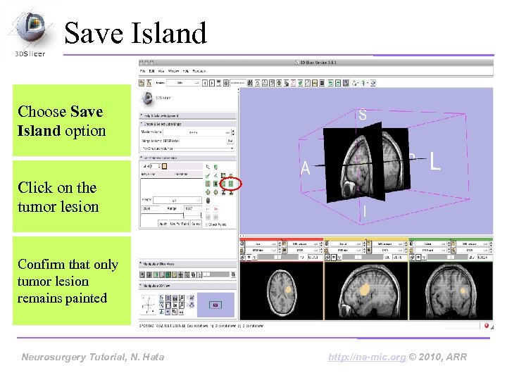 Save Island Choose Save Island option Click on the tumor lesion Confirm that only