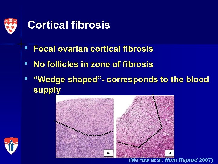 Cortical fibrosis • • • Focal ovarian cortical fibrosis No follicles in zone of