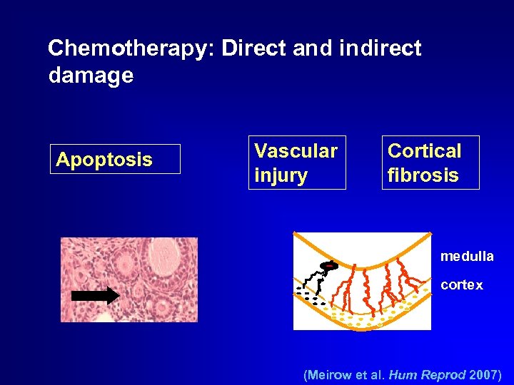 Chemotherapy: Direct and indirect damage Apoptosis Vascular injury Cortical fibrosis medulla cortex (Meirow et