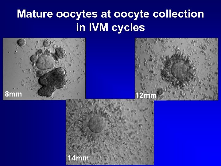 Mature oocytes at oocyte collection in IVM cycles 8 mm 12 mm 14 mm