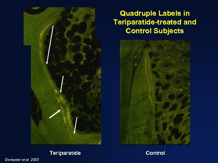 Quadruple Labels in Teriparatide-treated and Control Subjects Teriparatide Dempster et al. 2003 Control 