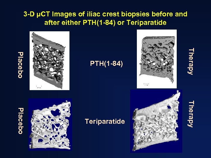 3 -D µCT Images of iliac crest biopsies before and after either PTH(1 -84)