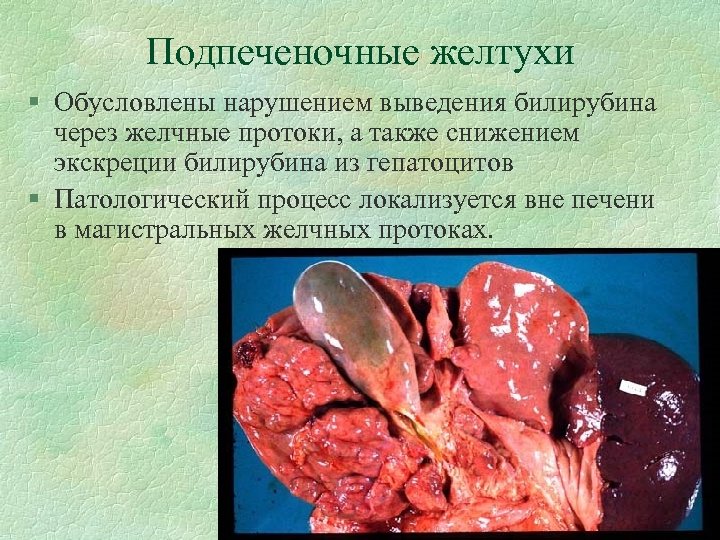 Подпеченочные желтухи § Обусловлены нарушением выведения билирубина через желчные протоки, а также снижением экскреции