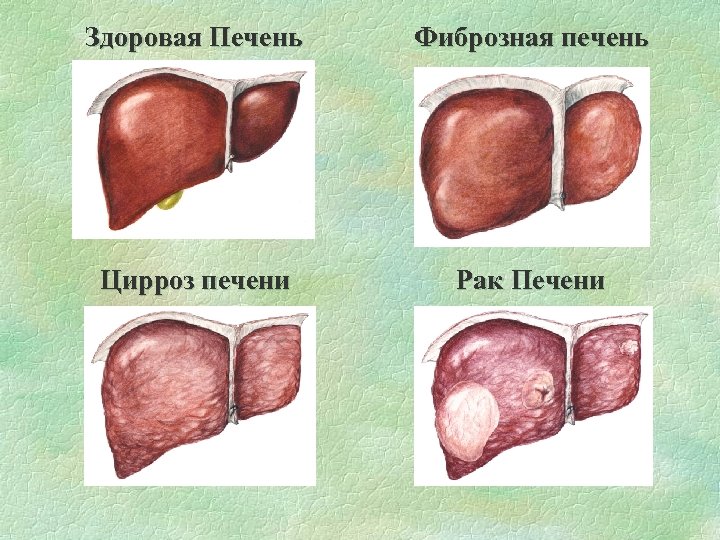 Здоровая Печень Фиброзная печень Цирроз печени Рак Печени 