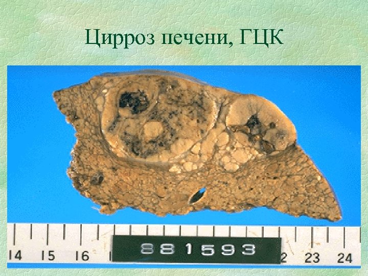 Цирроз печени, ГЦК 