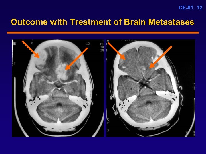 CE-01: 12 Outcome with Treatment of Brain Metastases 