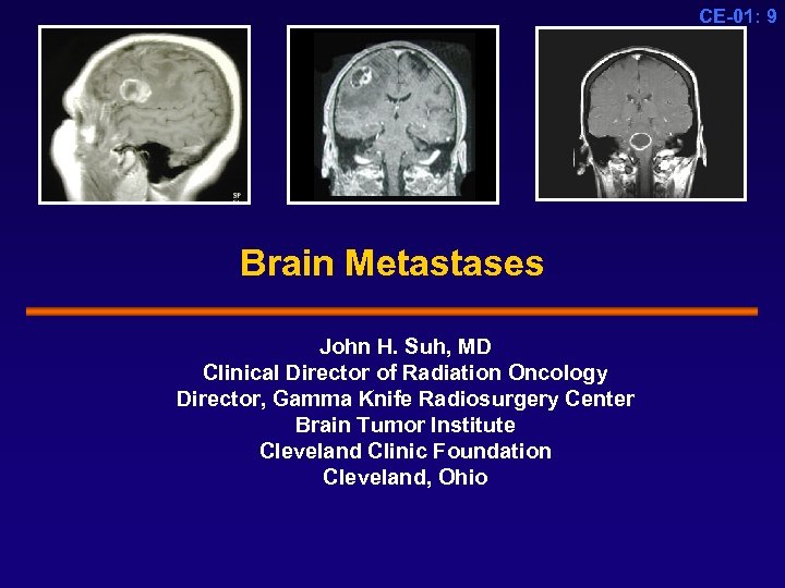 CE-01: 9 Brain Metastases John H. Suh, MD Clinical Director of Radiation Oncology Director,