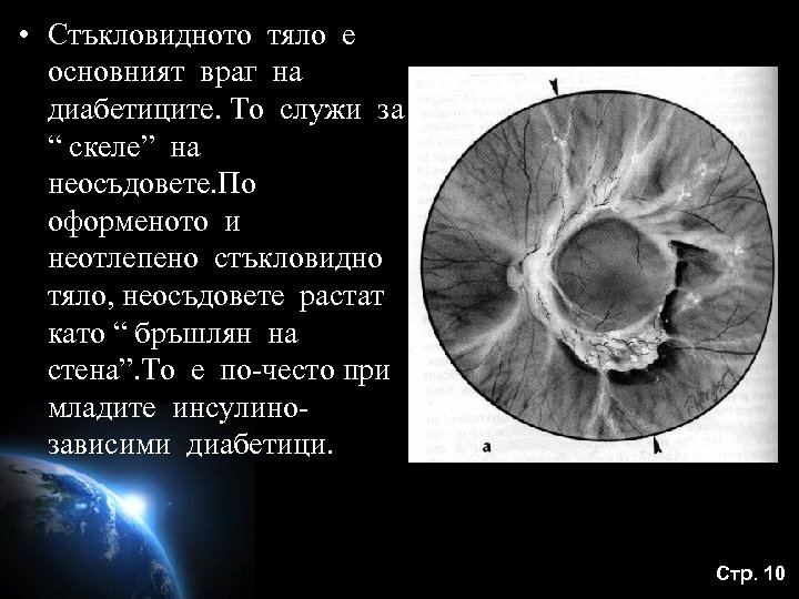  • Стъкловидното тяло е основният враг на диабетиците. То служи за “ скеле”