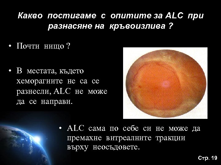 Какво постигаме с опитите за ALC при разнасяне на кръвоизлива ? • Почти нищо