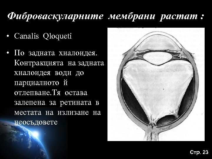 Фиброваскуларните мембрани растат : • Canalis Qloqueti • По задната хиалоидея. Контракцията на задната