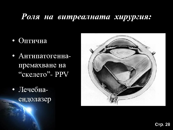 Роля на витреалната хирургия: • Оптична • Антипатогеннапремахване на “скелето”- PPV • Лечебнаендолазер Стр.