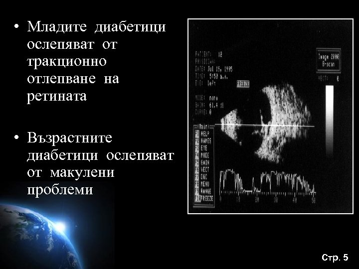  • Младите диабетици ослепяват от тракционно отлепване на ретината • Възрастните диабетици ослепяват