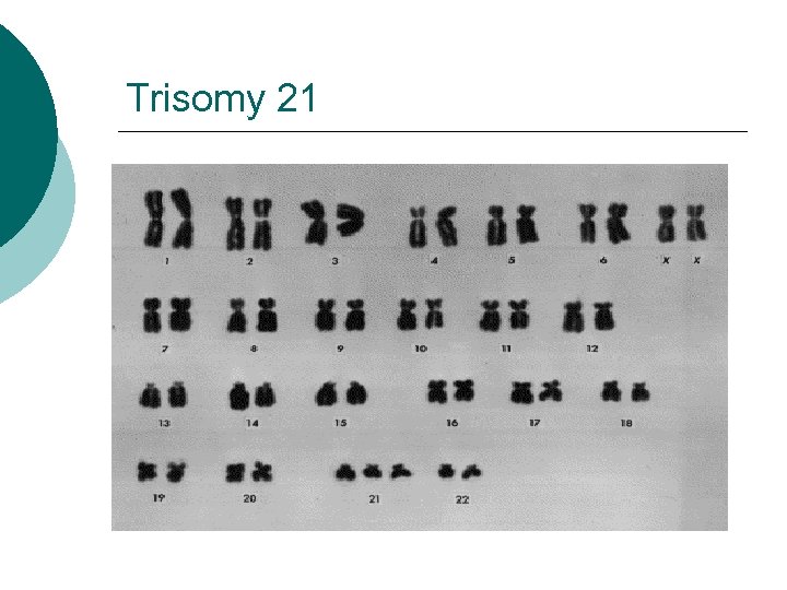 Trisomy 21 