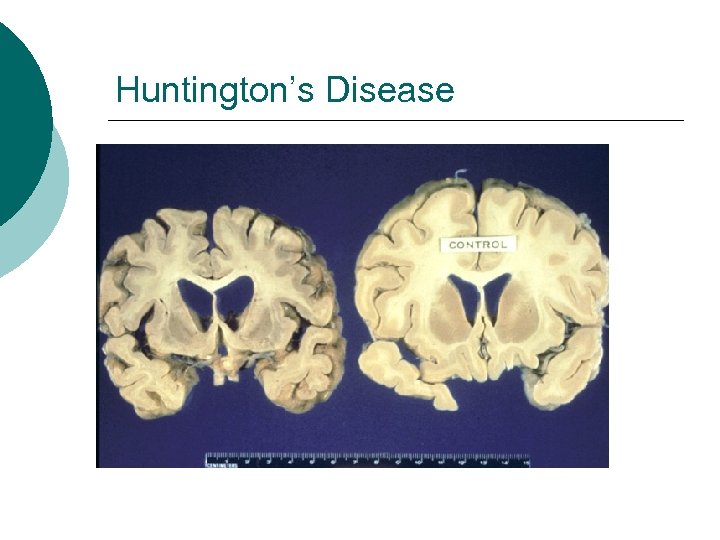 Huntington’s Disease 