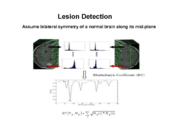 Lesion Detection Assume bilateral symmetry of a normal brain along its mid-plane 