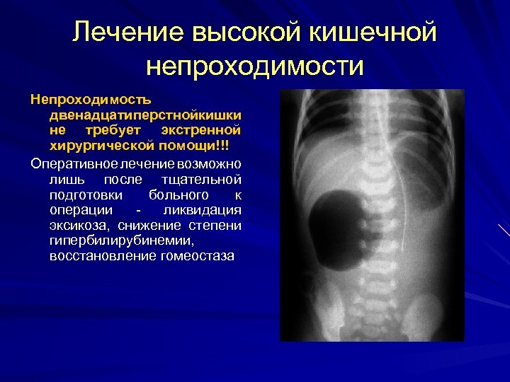 Лечение высокой кишечной непроходимости Непроходимость двенадцатиперстнойкишки не требует экстренной хирургической помощи!!! Оперативное лечение возможно
