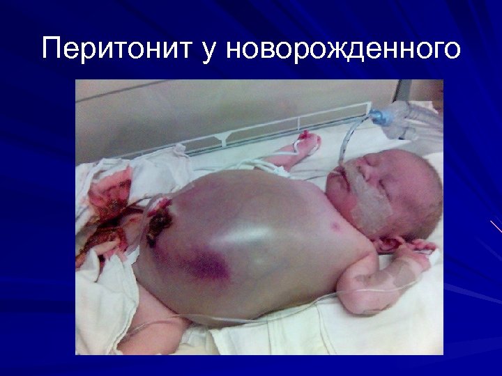 Перитонит у новорожденного 