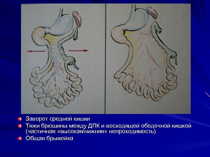 Заворот средней кишки Тяжи брюшины между ДПК и восходящей ободочной кишкой (частичная «высокая/нижняя» непроходимость)