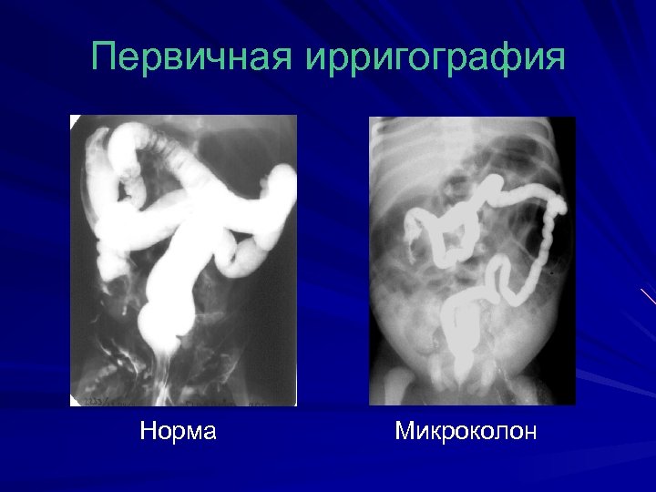 Первичная ирригография Норма Микроколон 