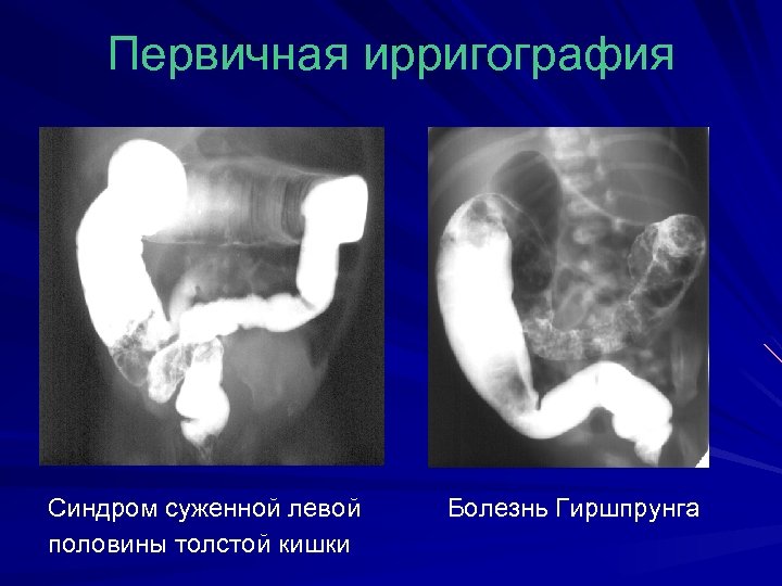 Первичная ирригография Синдром суженной левой Болезнь Гиршпрунга половины толстой кишки 