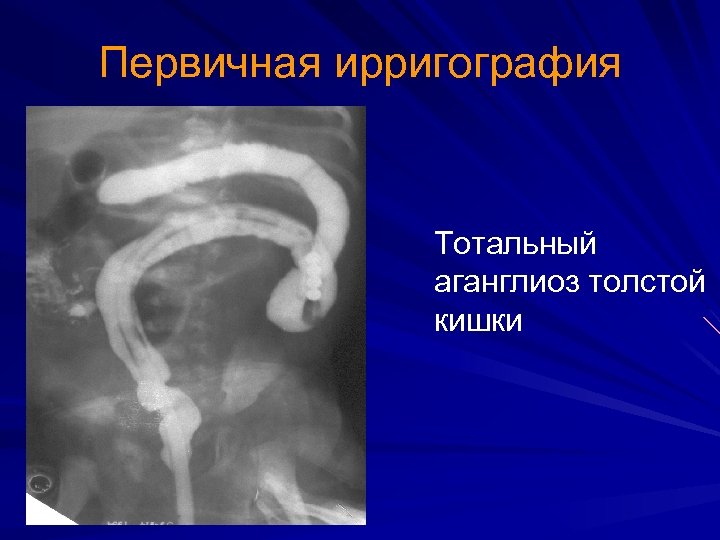 Первичная ирригография Тотальный аганглиоз толстой кишки 