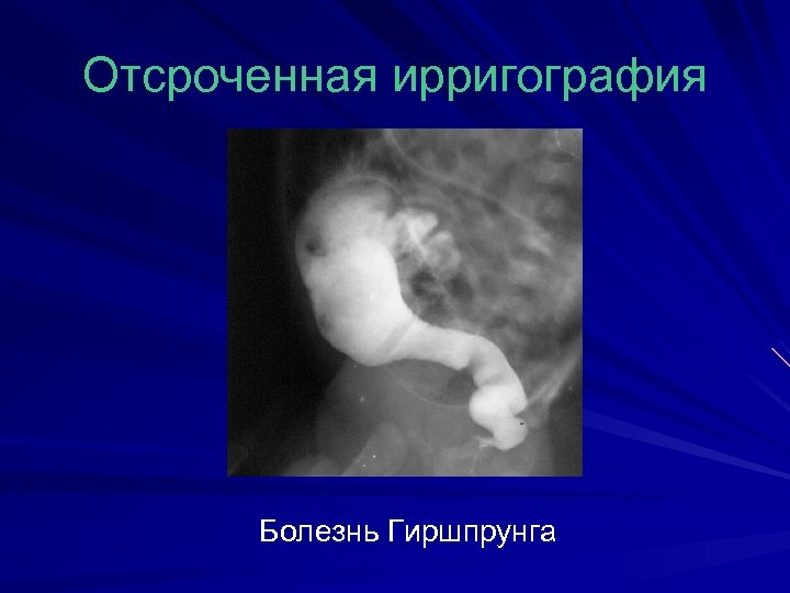 Отсроченная ирригография Болезнь Гиршпрунга 