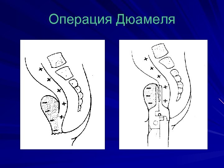 Операция Дюамеля 