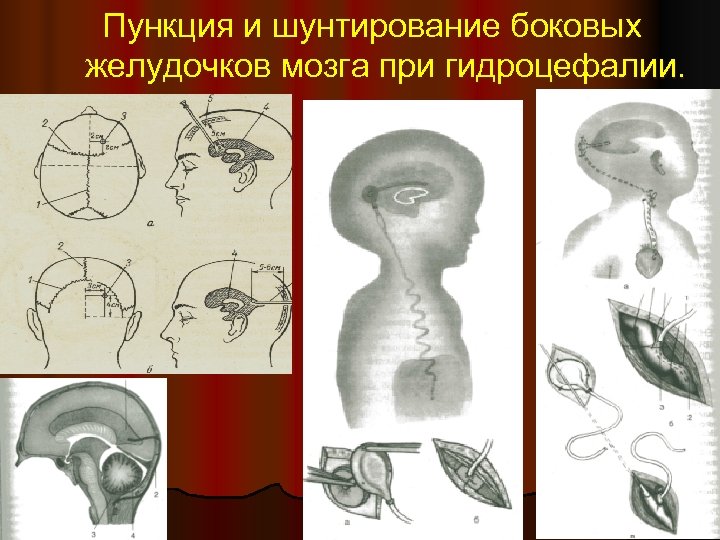 Шунтирование при гидроцефалии головного. Шунт при гидроцефалии схема. Шунтирование при гидроцефалии головного мозга у взрослого. Шунтирование желудочков мозга.