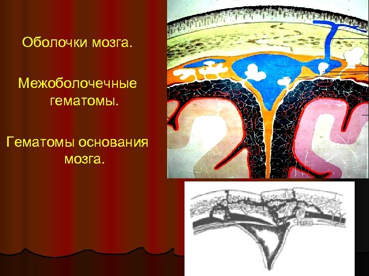 Оболочки мозга. Межоболочечные гематомы. Гематомы основания мозга. 