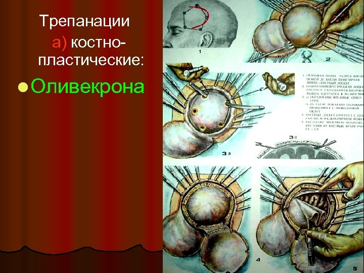 Костно пластическая трепанация черепа презентация