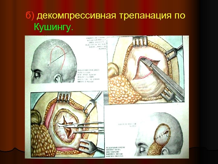 Черепно мозговая травма презентация хирургия