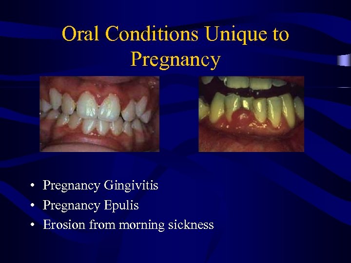 Oral Conditions Unique to Pregnancy • Pregnancy Gingivitis • Pregnancy Epulis • Erosion from