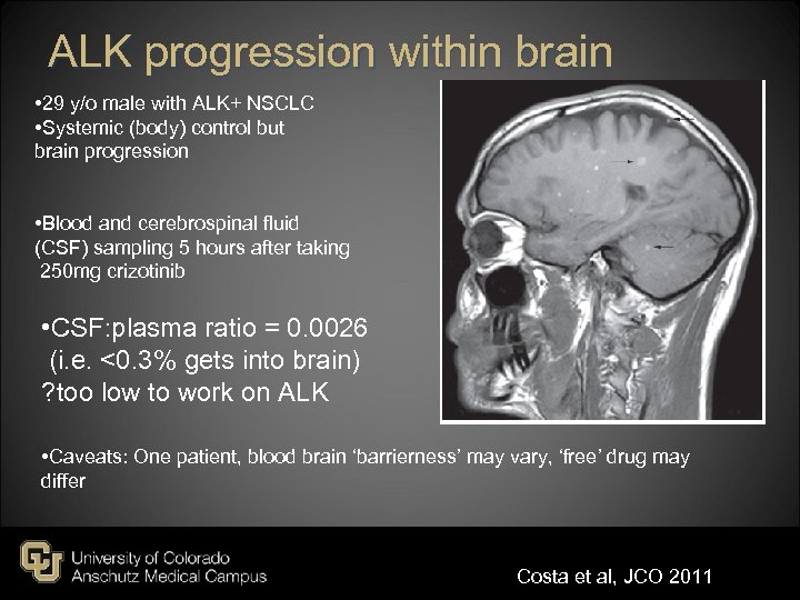 ALK progression within brain • 29 y/o male with ALK+ NSCLC • Systemic (body)