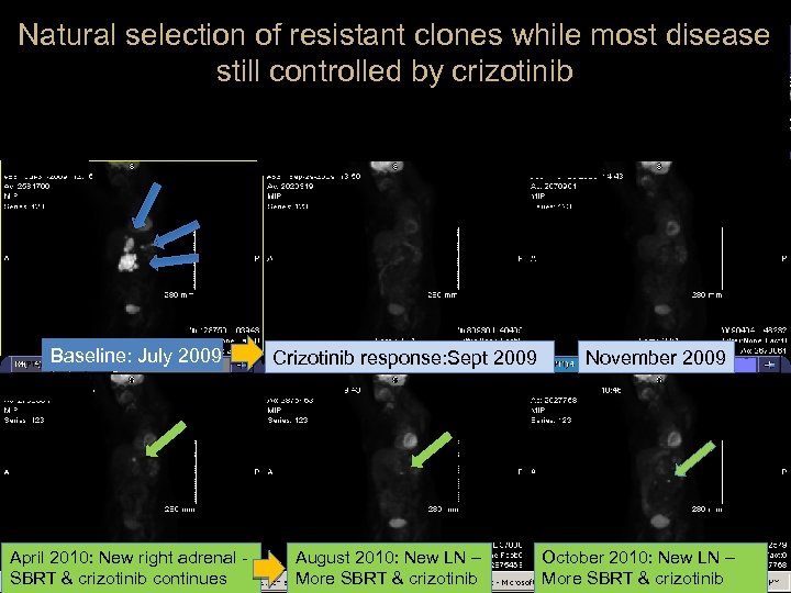 Natural selection of resistant clones while most disease still controlled by crizotinib Baseline: July